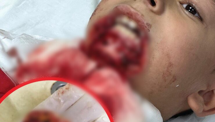 Çanakkale’de çenesine demir saplanan öğrencinin davasının 2’nci duruşması görüldü